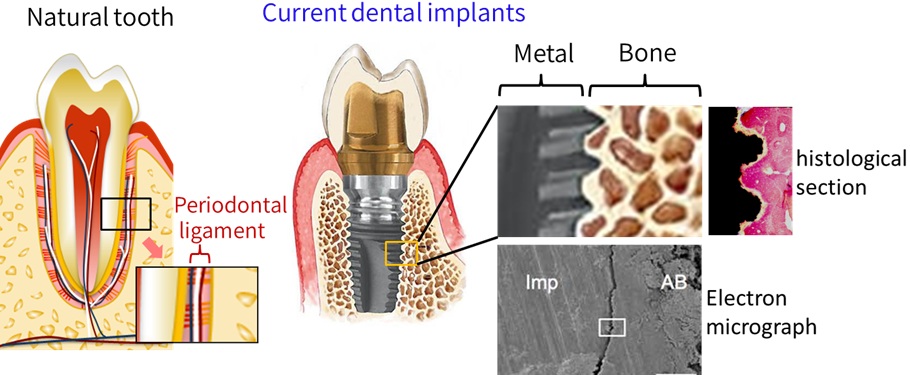 Figure 1: Conventional implant and periodontal ligament