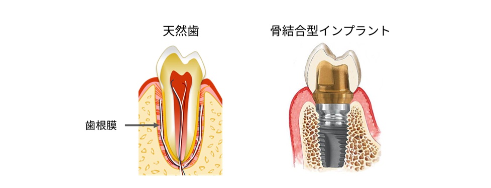 図3 デンタルインプラントと歯根膜